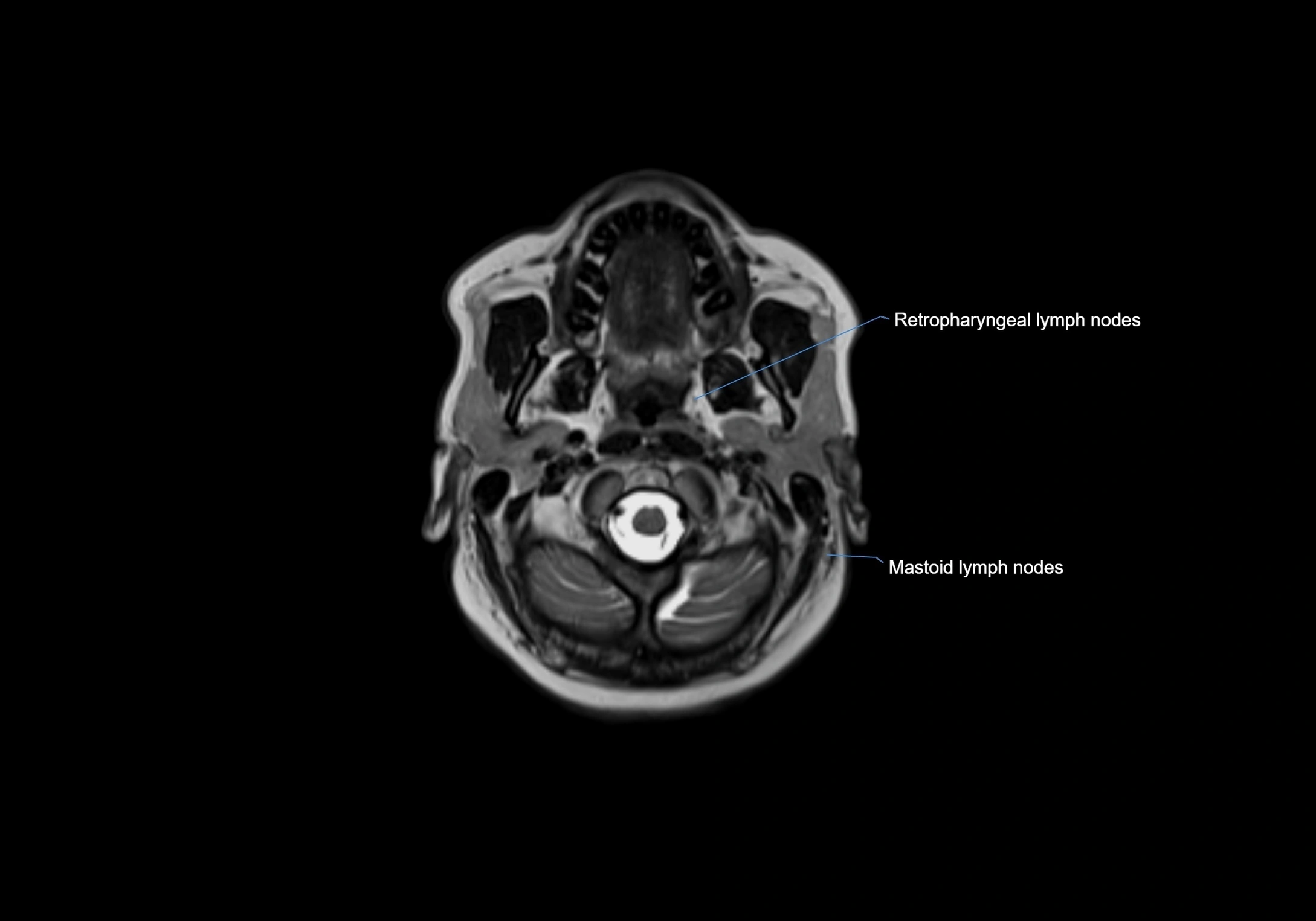 Neck axial  lymph node cross sectional MRI anatomy 3T MRI  image-img-00001-00028.webp